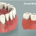 مقایسه دنتال بریج با ایمپلنت دندان