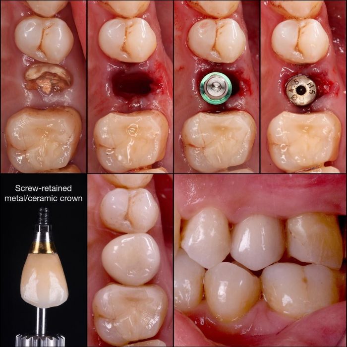 ایمپلنت دندان در مطب دکتر مهناز ارشد