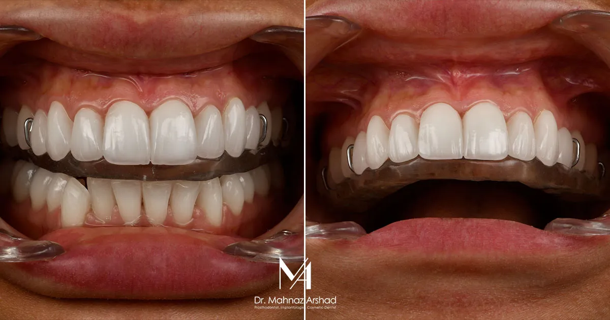 اختلال مفصل گیجگاهی فکی