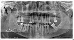 عکس رادیولوژی برای عصب کشی دندان