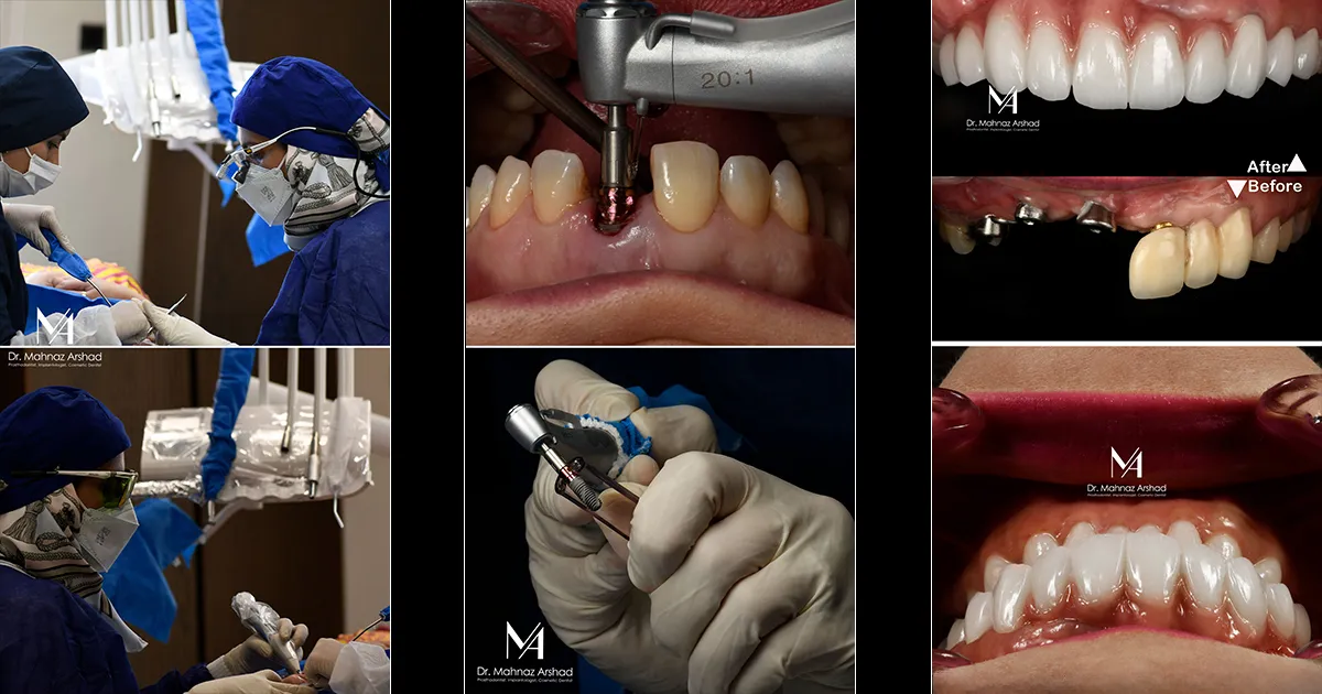 ایمپلنت دندان در ظفر