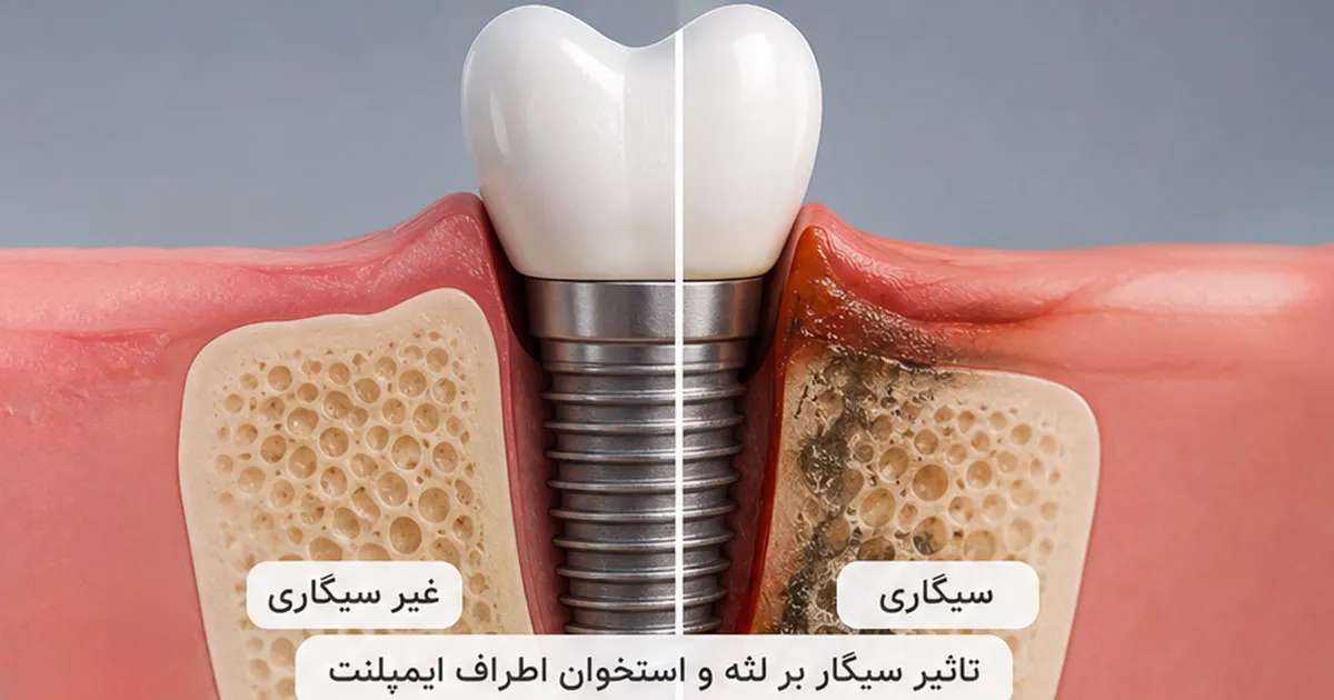 تاثیر سیگار بر لثه