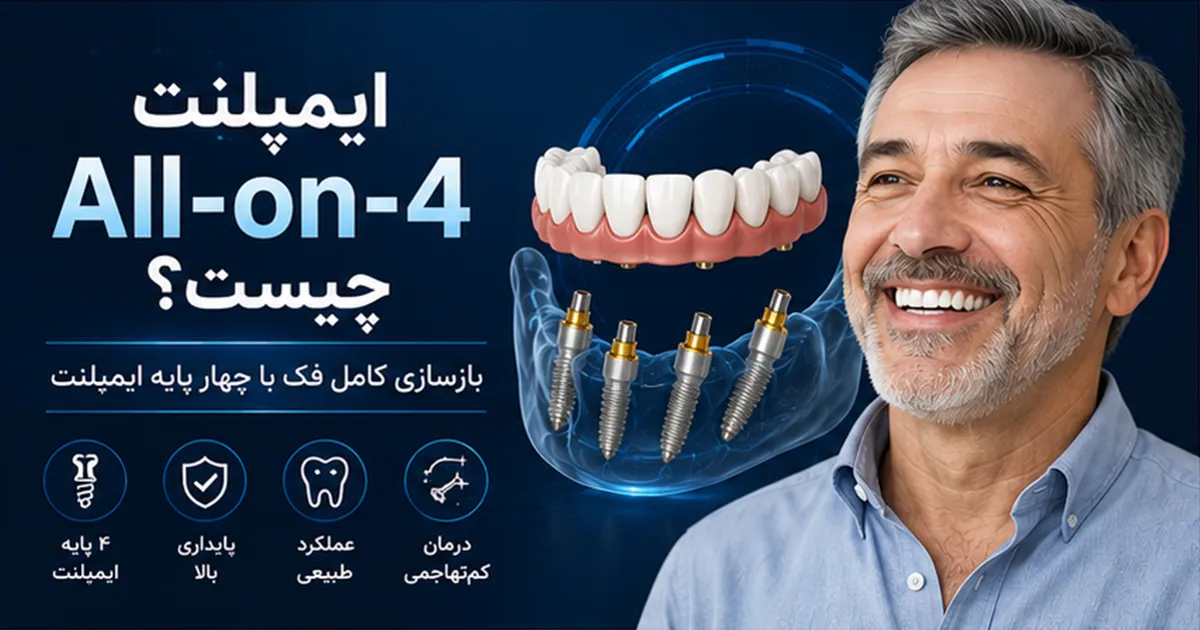 ایمپلنت 4‏-‏ All-on چیست و برای چه کسانی مناسب است؟