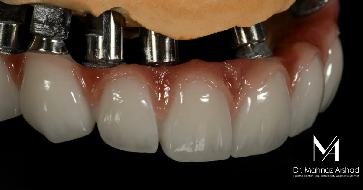 بریج زیرکونیا