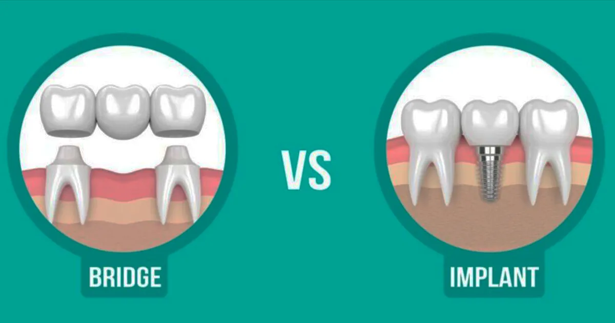بریج دندان بهتر است یا ایمپلنت؟