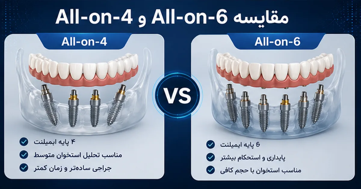 تفاوت ایمپلنت All on 4 با All on 6