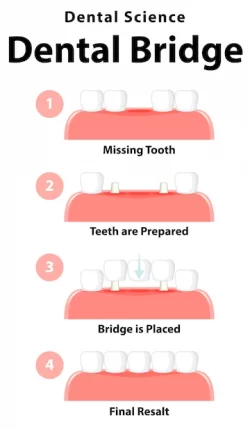 مراحل نصب بریج روی دندان