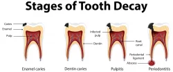 مراحل خرابی و آبسه دندان