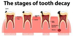 پوسیدگی سطحی دندان