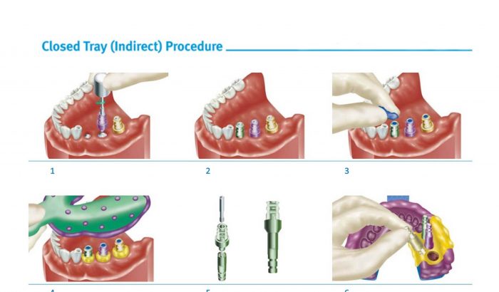 پایه ایمپلنت دندان