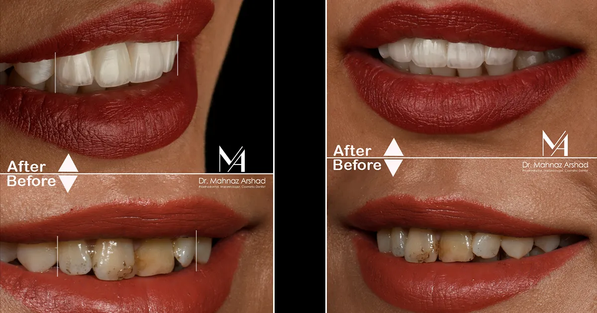 اصلاح نامرتبی خفیف دندان