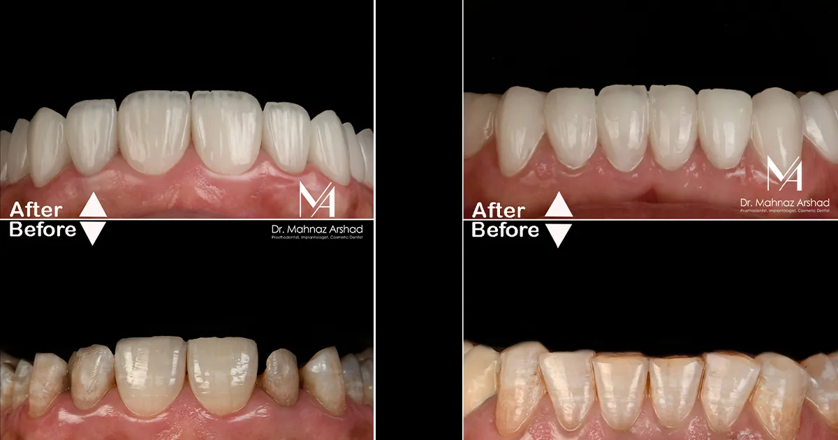 لومینیرز دندان