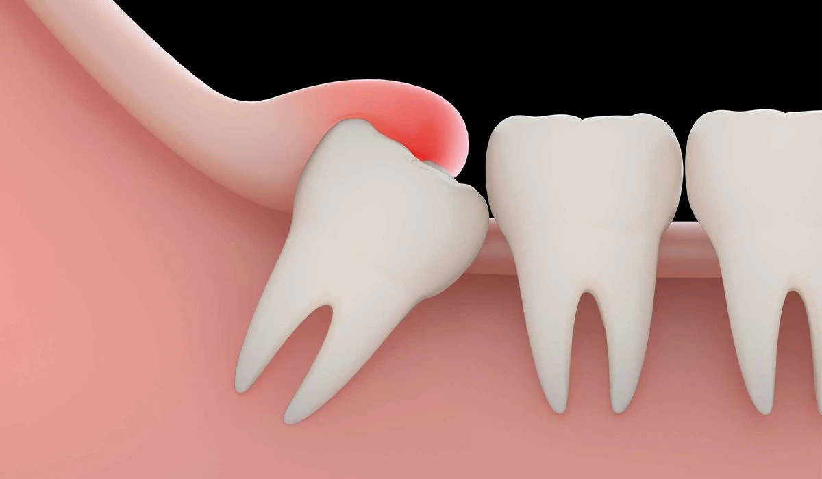 محل درد گرفتن دندان عقل