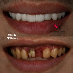 ایمپلنت دندان روشی برای رفع بی دندانی