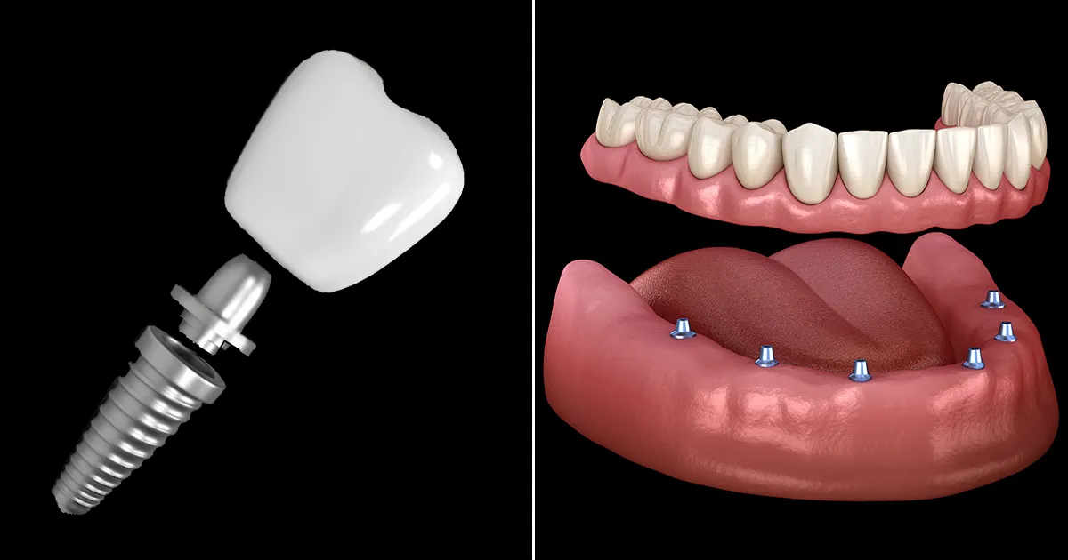 ایمپلنت فک بالا و پایین
