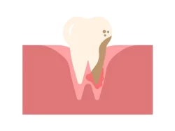 آیا جرم گیری دندان درد دارد