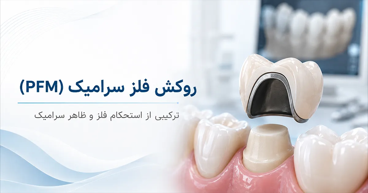 روکش فلز سرامیک