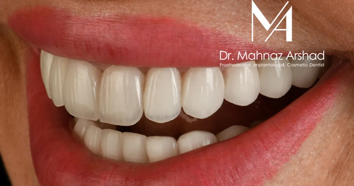 روکش تمام سرامیک