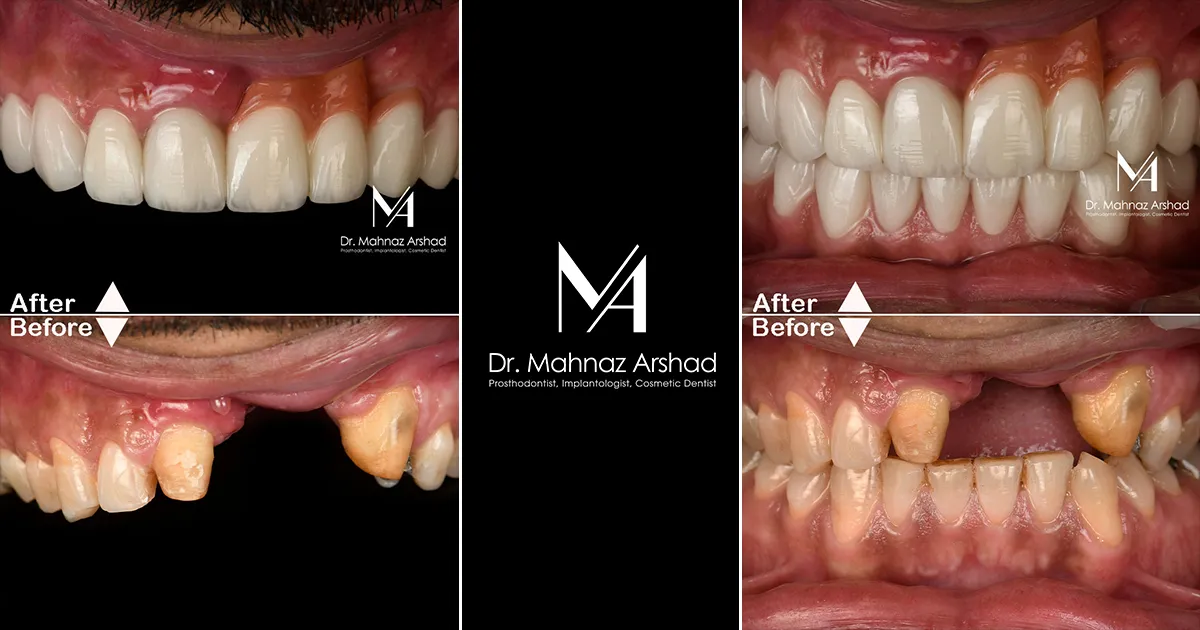 ایمپلنت دندان در شمال تهران