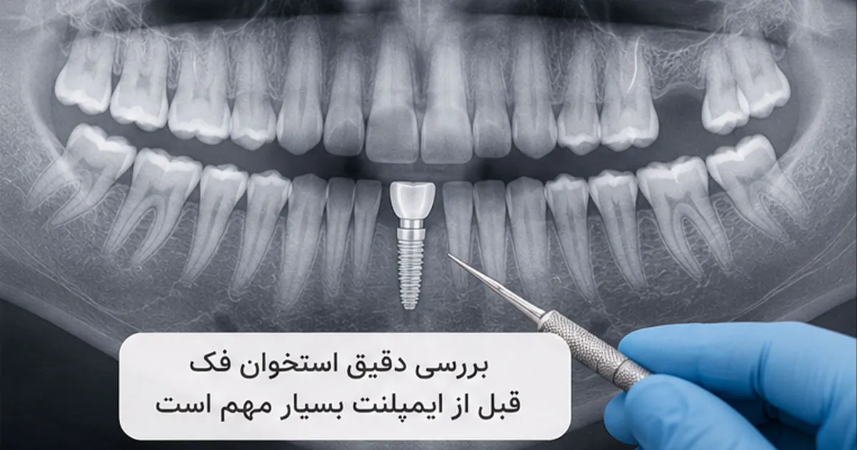 بررسی استخوان قبل از ایمپلنت