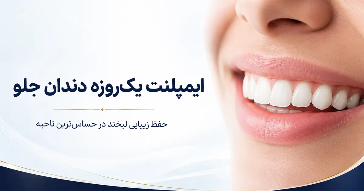 ایمپلنت یک ‌روزه دندان جلو