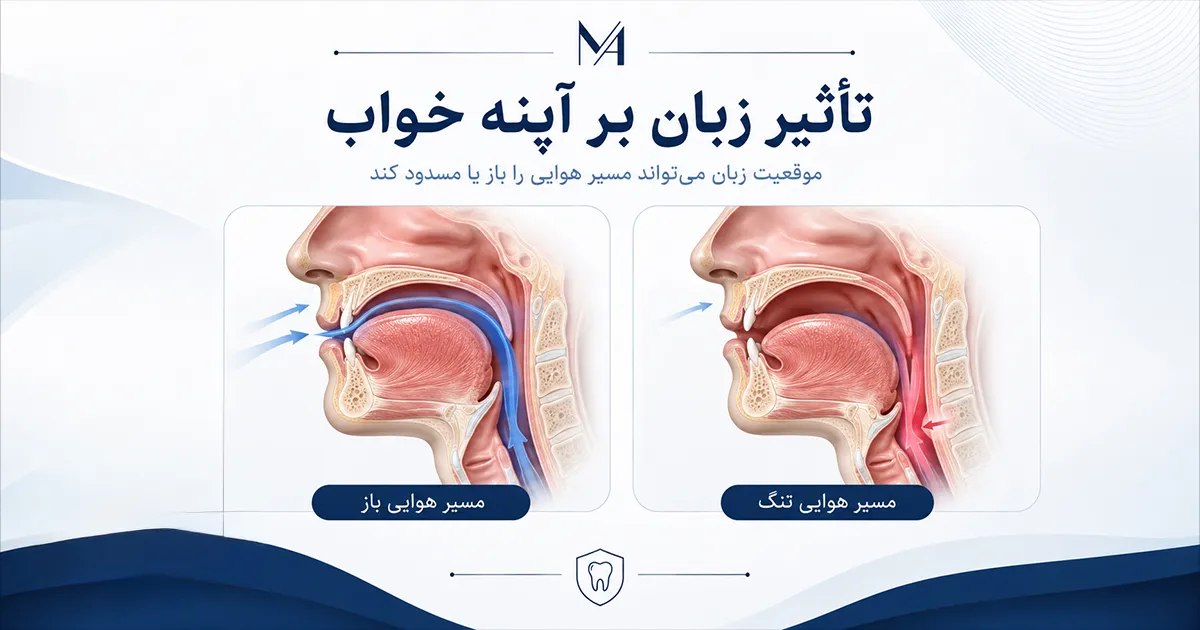 تاثیر زبان بر آپنه خواب