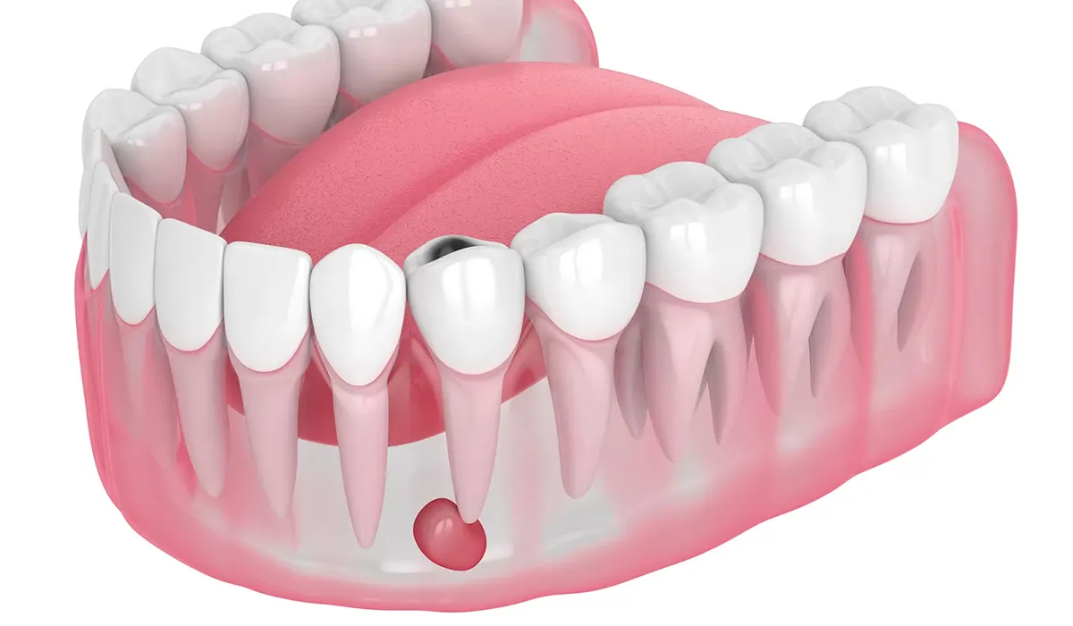 tooth abscess