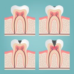 علائم پوسیدگی دندان 
