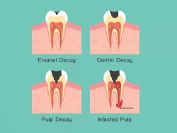 نمایی از پوسیدگی دندان