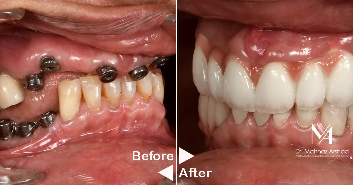 ایمپلنت دندان چقدر طول میکشد؟