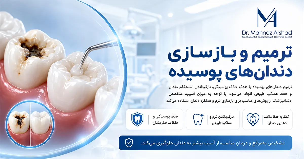 ترمیم و بازسازی دندان های پوسیده