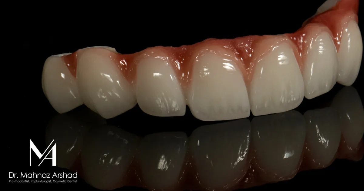 آیا بریج دندان دائمی است؟