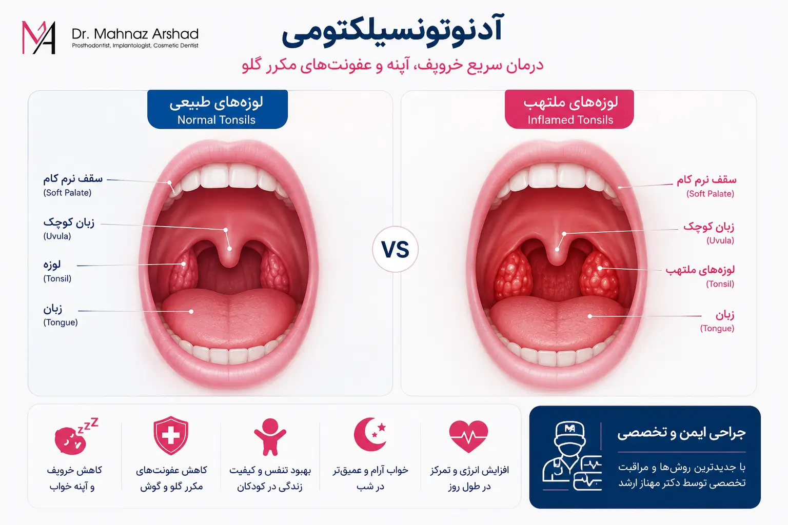 آدنوتونسیلکتومی