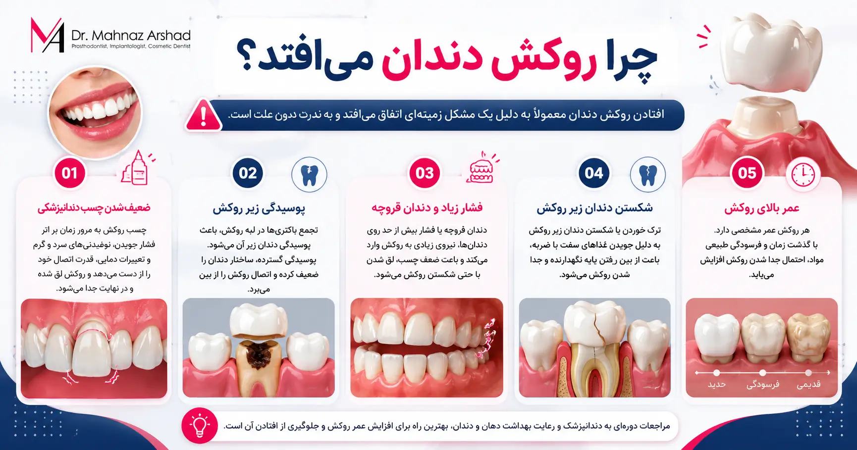 روکش دندان