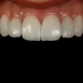 لمینت دندان برای دندان های لکه دار: راه حلی برای داشتن لبخندی سفید و درخشان
