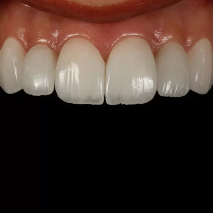 لمینت دندان برای دندان های لکه دار: راه حلی برای داشتن لبخندی سفید و درخشان