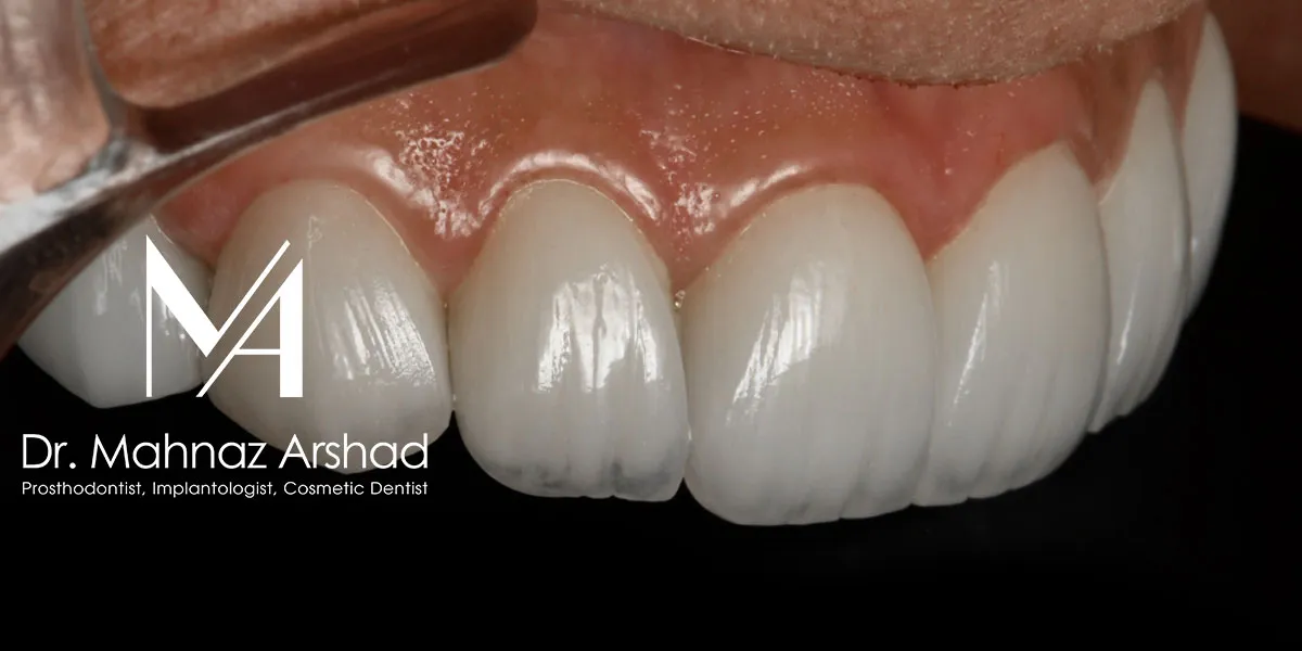 دوره ریکاوری لمینیت دندان چقدر است؟