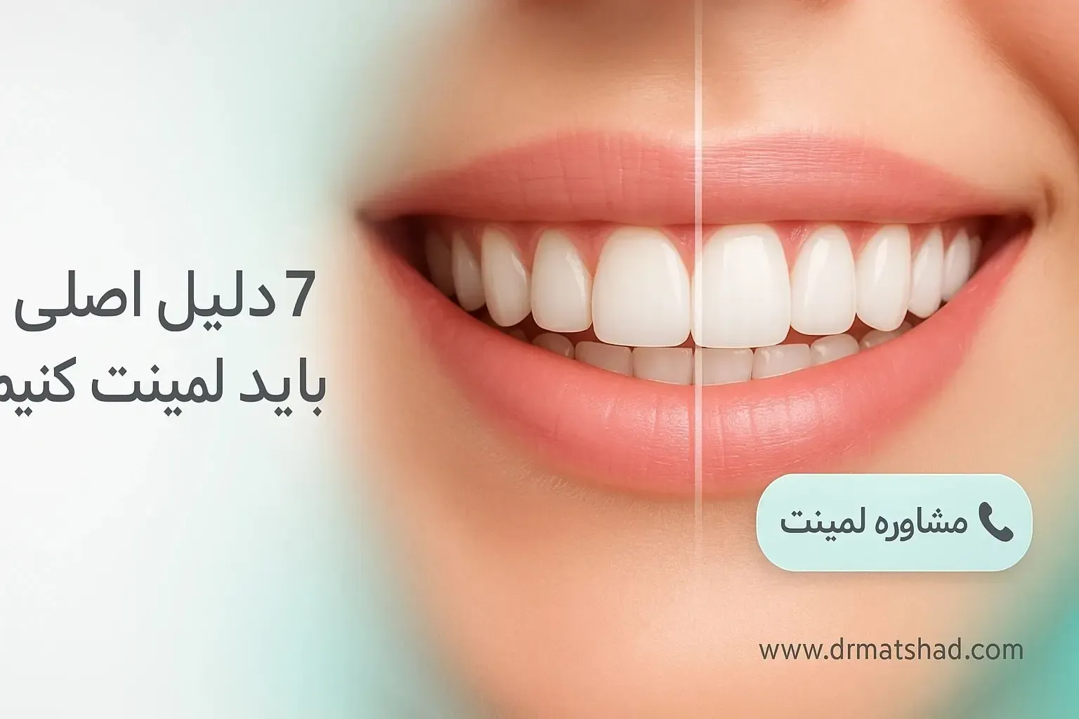 لمینت دندان